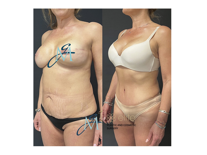 Addominoplastica – Tummy Tuck Lecce Milano Parma